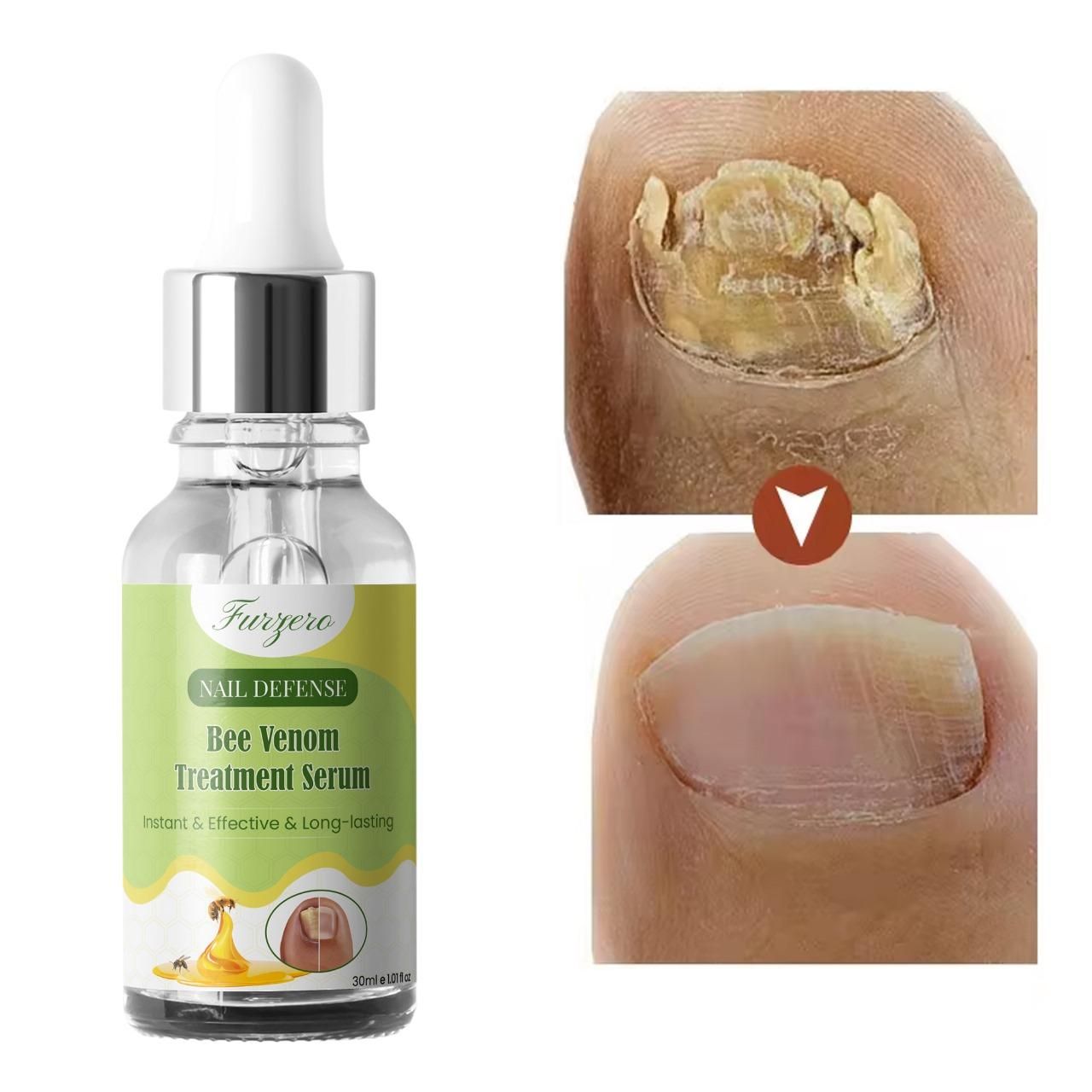 Furgero Nail Care Serum with Bee Venom Extract 30ml (Pack of 1)