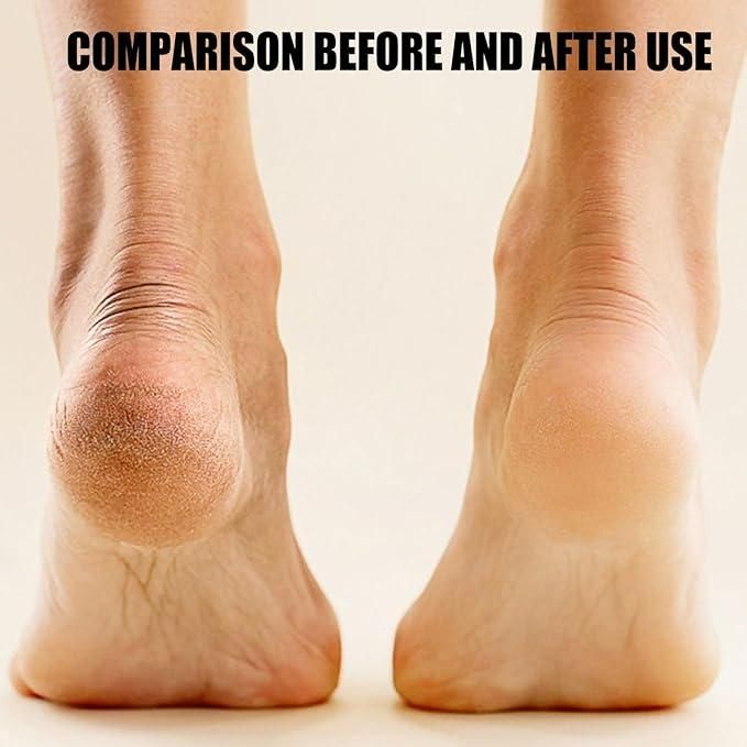 Electronic Pedicure Tool – Electric Callus Remover for Smooth, Soft Feet, Pack of 1